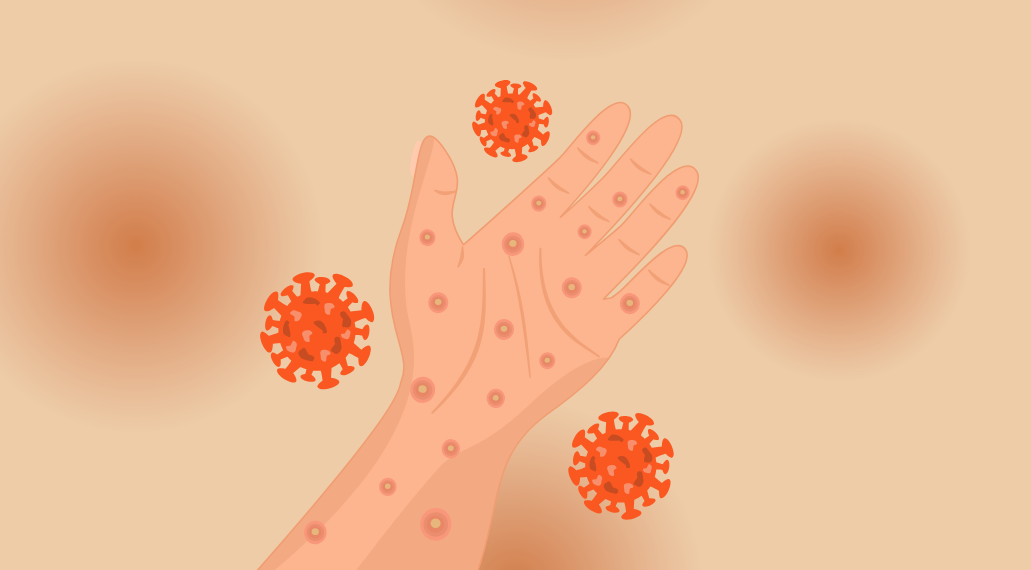 Ketika Imunisasi Terlewat, Campak Mengancam Anak