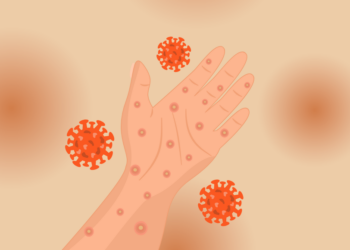 Ketika Imunisasi Terlewat, Campak Mengancam Anak