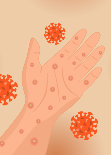 Ketika Imunisasi Terlewat, Campak Mengancam Anak