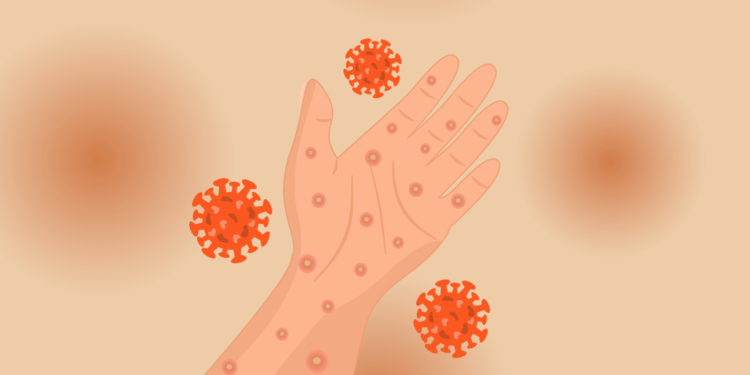 Ketika Imunisasi Terlewat, Campak Mengancam Anak